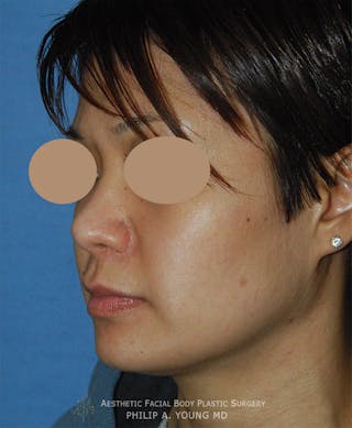 Rhinoplasty Before & After Gallery - Patient 400739 - Image 2