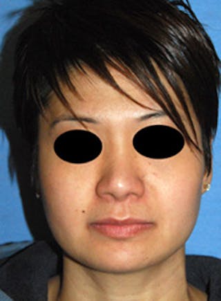 Rhinoplasty Before & After Gallery - Patient 400739 - Image 4