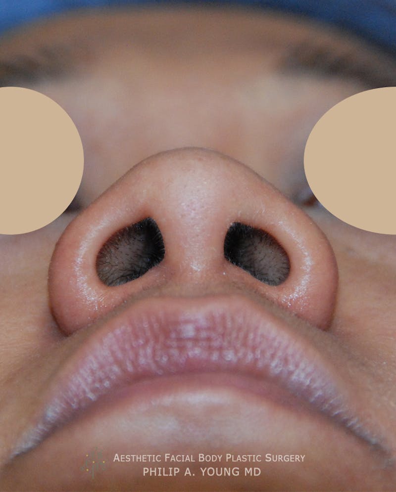 Asian Rhinoplasty Before & After Gallery - Patient 213701 - Image 5
