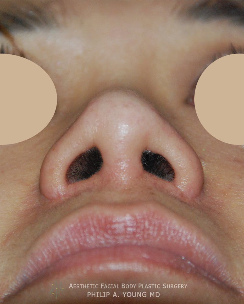 Asian Rhinoplasty Before & After Gallery - Patient 213701 - Image 6