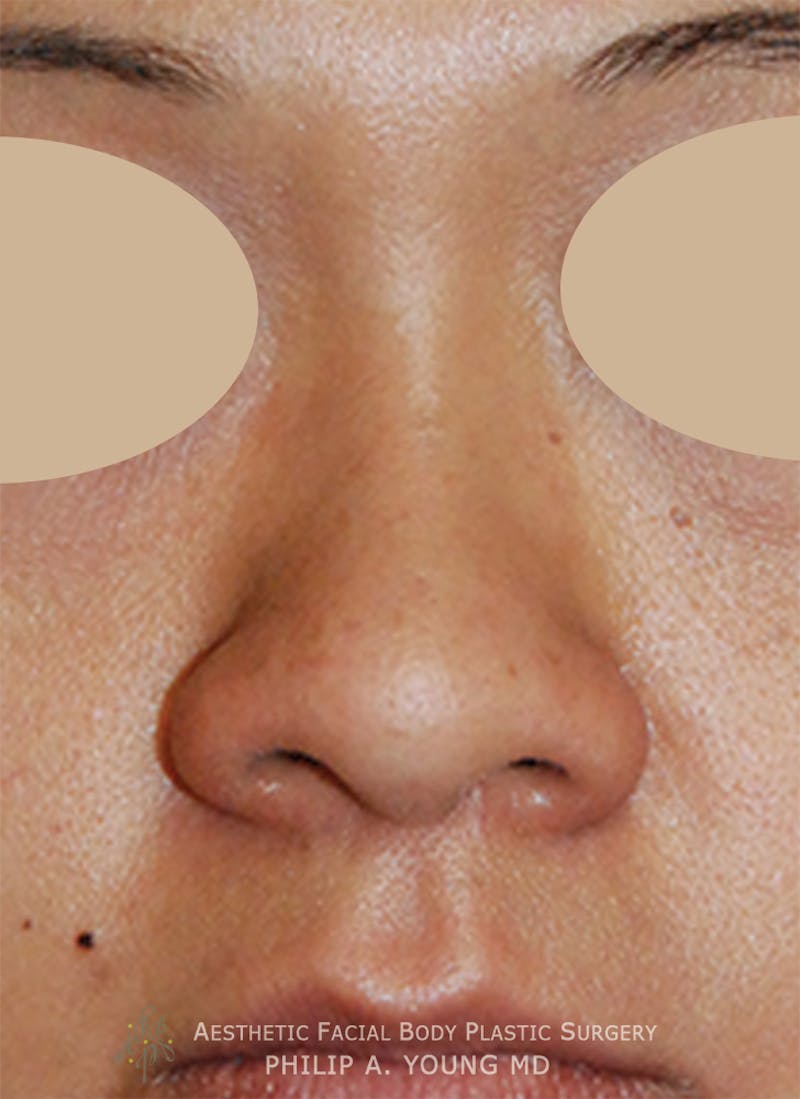 Asian Rhinoplasty Before & After Gallery - Patient 213701 - Image 7