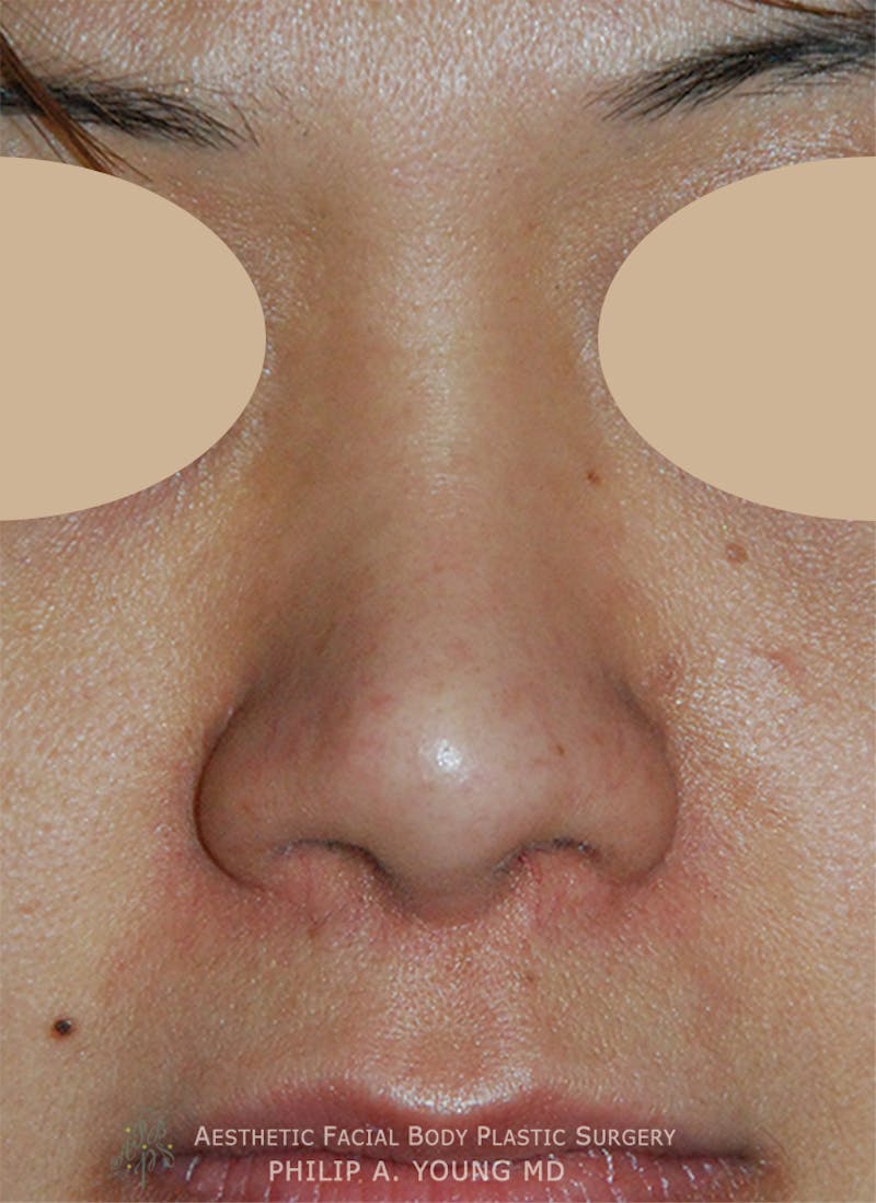 Asian Rhinoplasty Before & After Gallery - Patient 213701 - Image 8