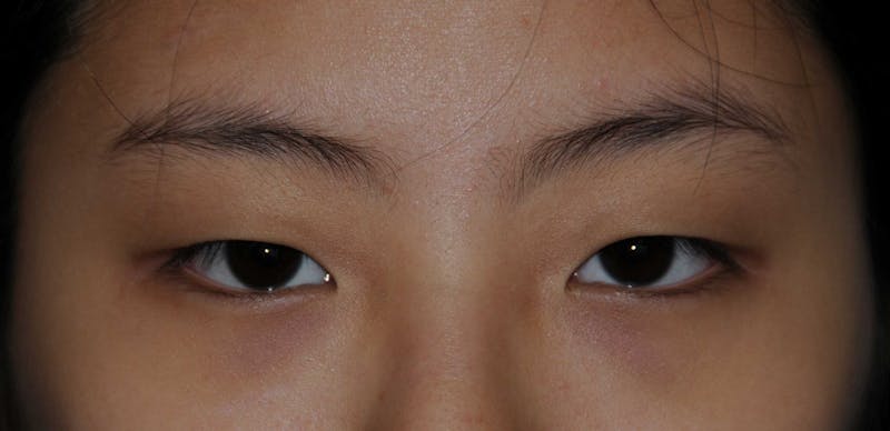 Asian / Ethnic Surgery Before & After Gallery - Patient 121063 - Image 1
