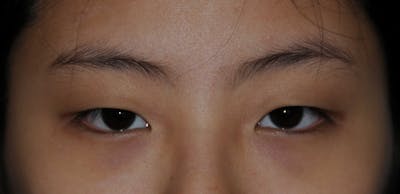 Asian / Ethnic Surgery Before & After Gallery - Patient 121063 - Image 1