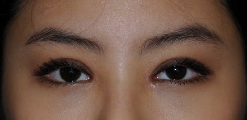 Asian / Ethnic Surgery Before & After Gallery - Patient 121063 - Image 2