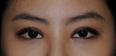 Asian / Ethnic Surgery Before & After Gallery - Patient 121063 - Image 2
