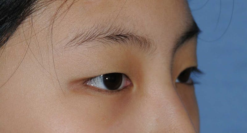 Asian / Ethnic Surgery Before & After Gallery - Patient 121063 - Image 3