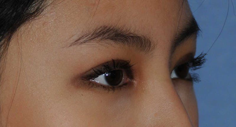 Asian / Ethnic Surgery Before & After Gallery - Patient 121063 - Image 4