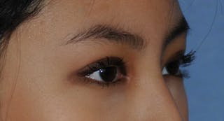 Asian / Ethnic Surgery Before & After Gallery - Patient 121063 - Image 4