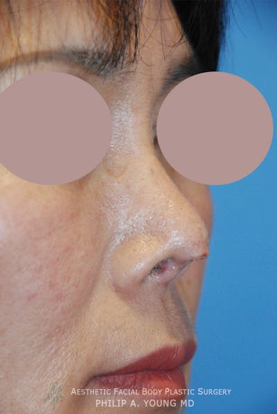 Rhinoplasty Before & After Gallery - Patient 183487 - Image 1