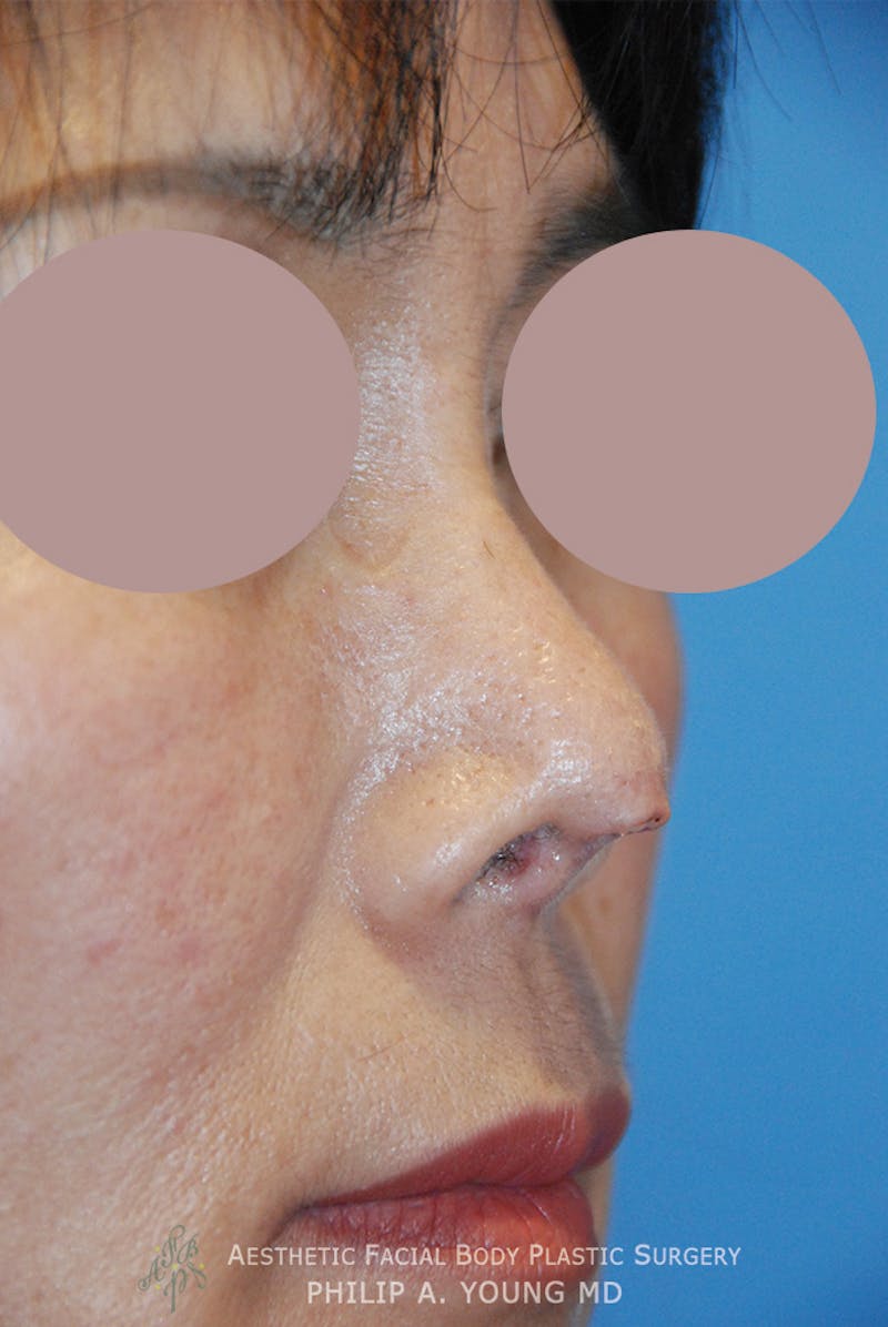 Asian Rhinoplasty Before & After Gallery - Patient 379209 - Image 1