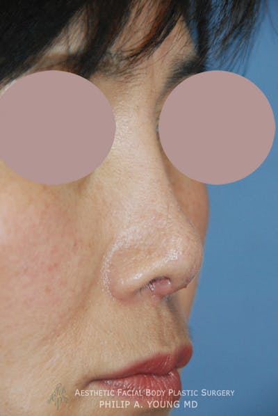 Rhinoplasty Before & After Gallery - Patient 183487 - Image 2