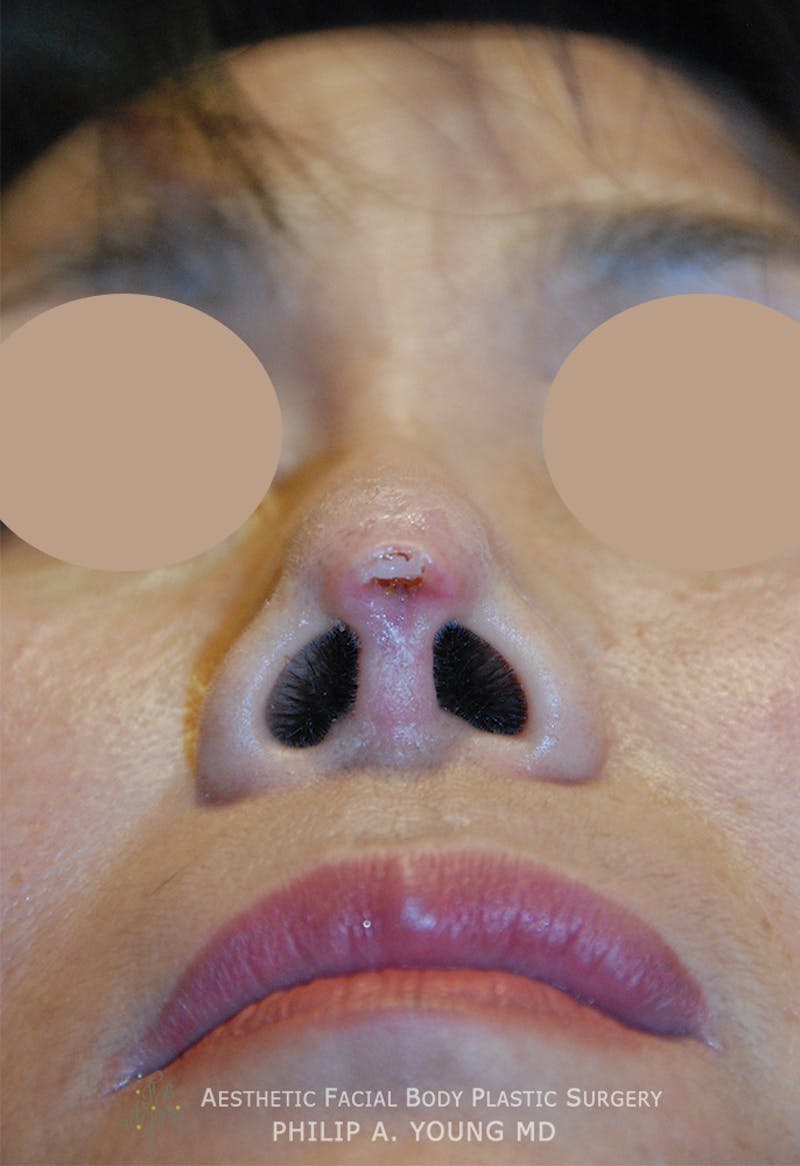 Asian Rhinoplasty Before & After Gallery - Patient 379209 - Image 3