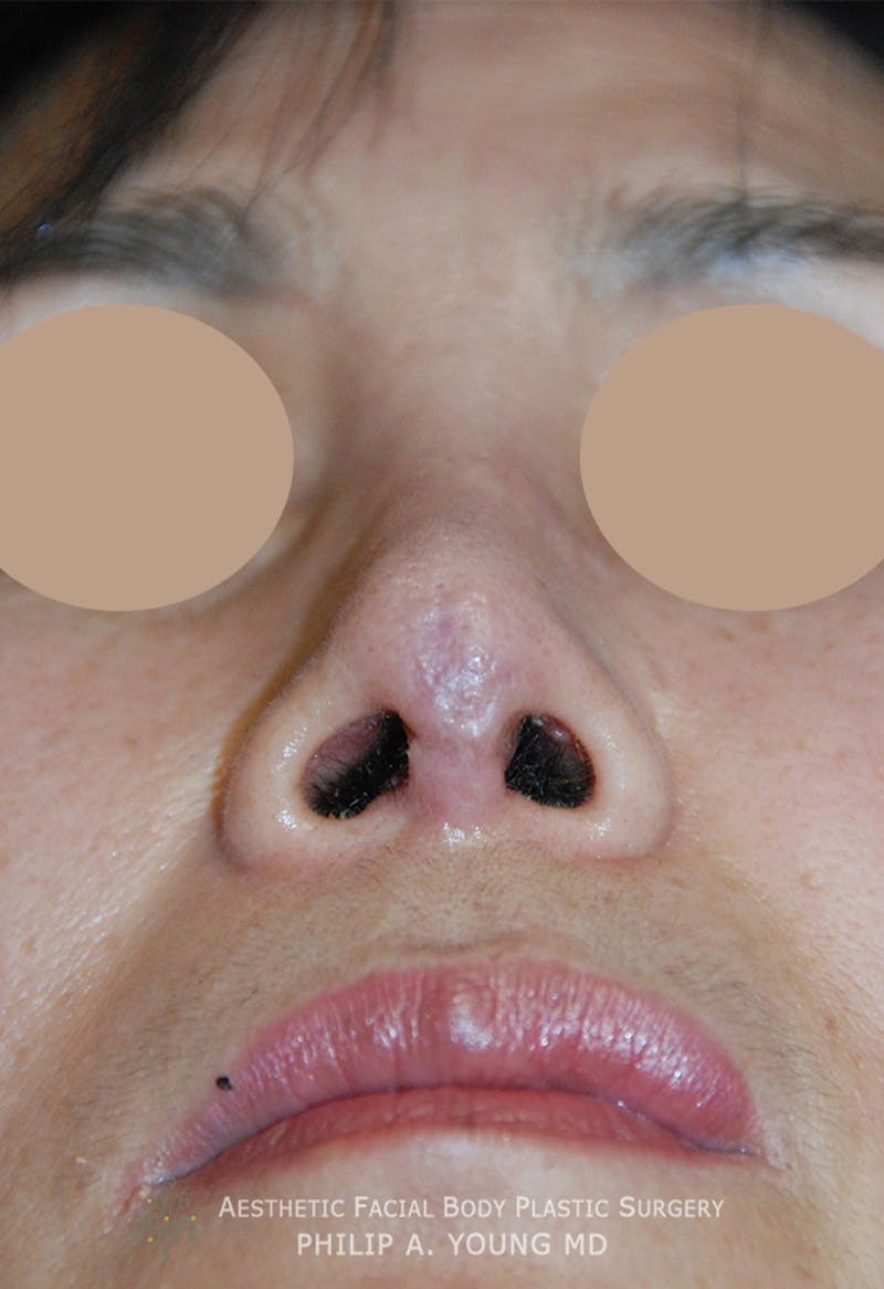Asian Rhinoplasty Before & After Gallery - Patient 379209 - Image 4