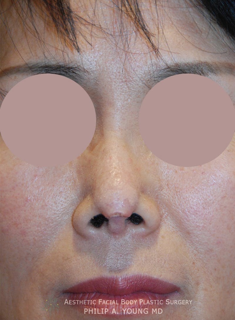 Asian Rhinoplasty Before & After Gallery - Patient 379209 - Image 5