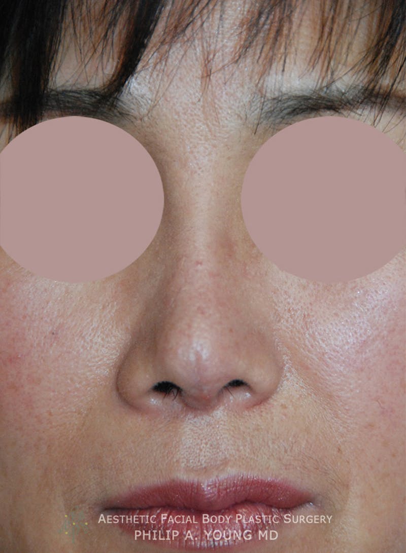Asian Rhinoplasty Before & After Gallery - Patient 379209 - Image 6
