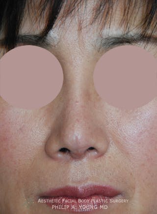 Asian / Ethnic Surgery Before & After Gallery - Patient 121363 - Image 6