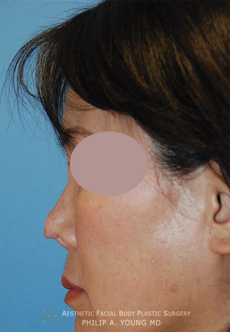Asian Rhinoplasty Before & After Gallery - Patient 379209 - Image 7