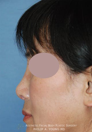 Asian / Ethnic Surgery Before & After Gallery - Patient 121363 - Image 8