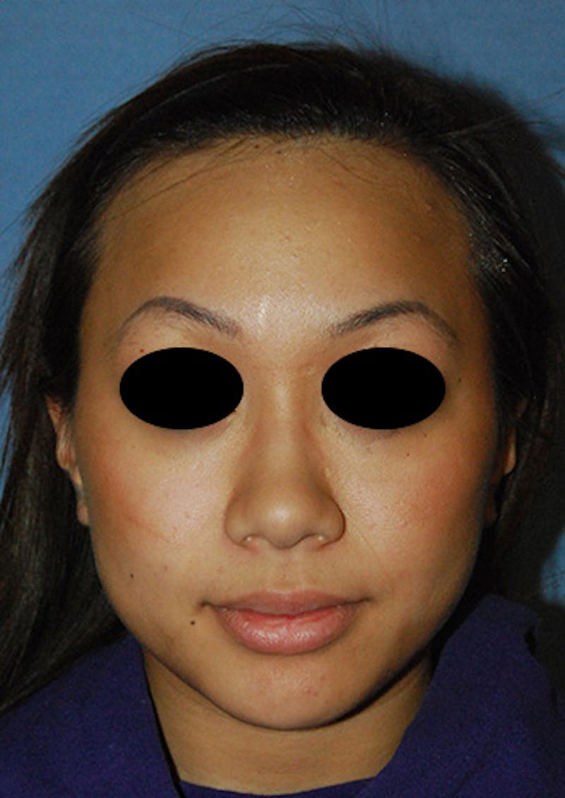Asian / Ethnic Surgery Before & After Gallery - Patient 799523 - Image 1