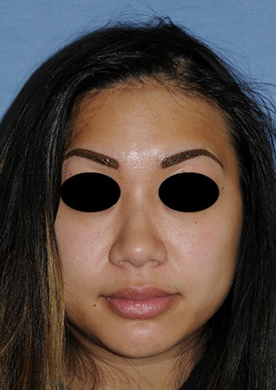 Asian / Ethnic Surgery Before & After Gallery - Patient 799523 - Image 2