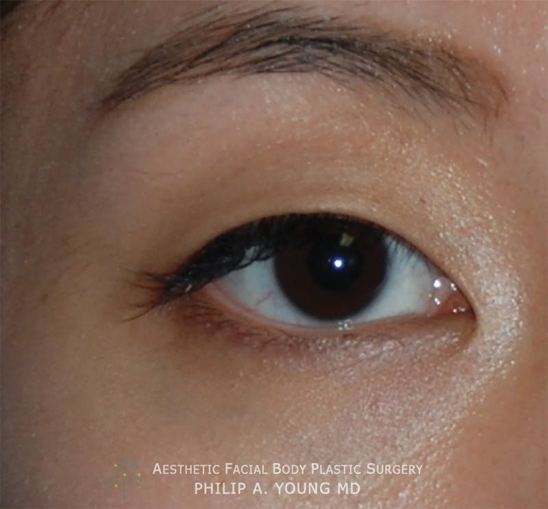 Asian / Ethnic Surgery Before & After Gallery - Patient 297668 - Image 1