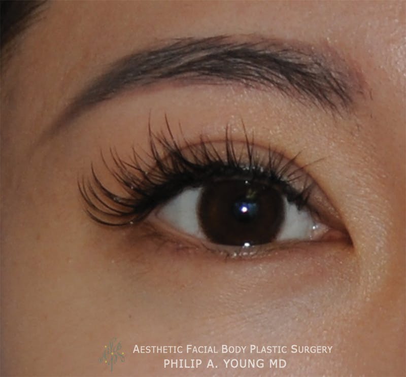 Asian / Ethnic Surgery Before & After Gallery - Patient 297668 - Image 2