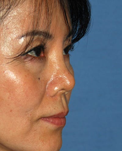 Rhinoplasty Before & After Gallery - Patient 359523 - Image 1