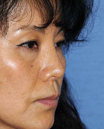 Rhinoplasty Before & After Gallery - Patient 359523 - Image 2
