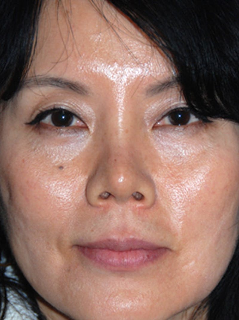 Asian Rhinoplasty Before & After Gallery - Patient 255029 - Image 3