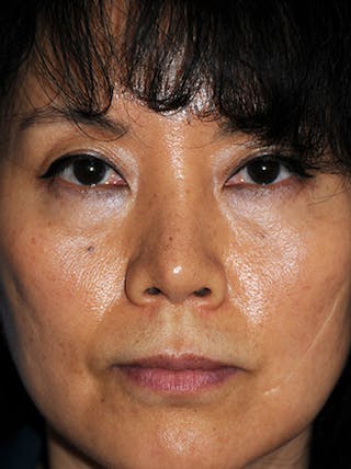 Asian Rhinoplasty Before & After Gallery - Patient 255029 - Image 4