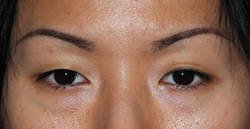 Eye Lift Before & After Gallery - Patient 732770 - Image 1