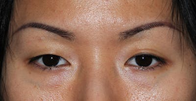 Asian / Ethnic Surgery Before & After Gallery - Patient 273436 - Image 1