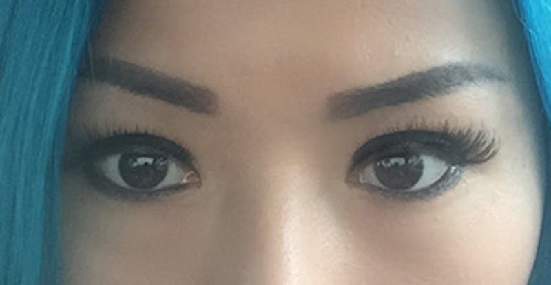 Eye Lift Before & After Gallery - Patient 732770 - Image 2