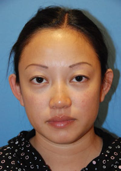 Asian / Ethnic Surgery Before & After Gallery - Patient 145618 - Image 1