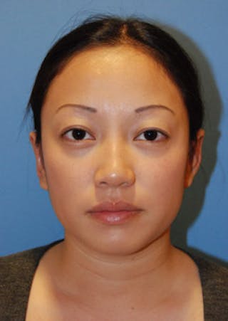 Ear Otoplasty Before & After Gallery - Patient 721663 - Image 2