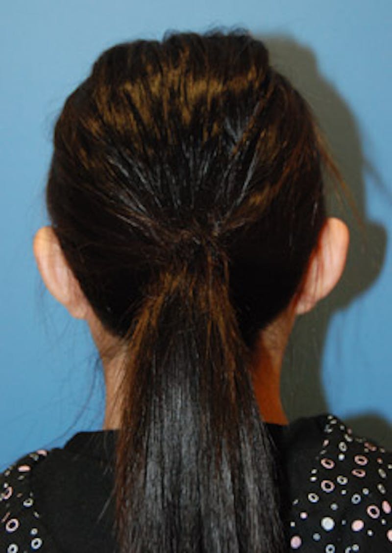 Ear Otoplasty Before & After Gallery - Patient 721663 - Image 3