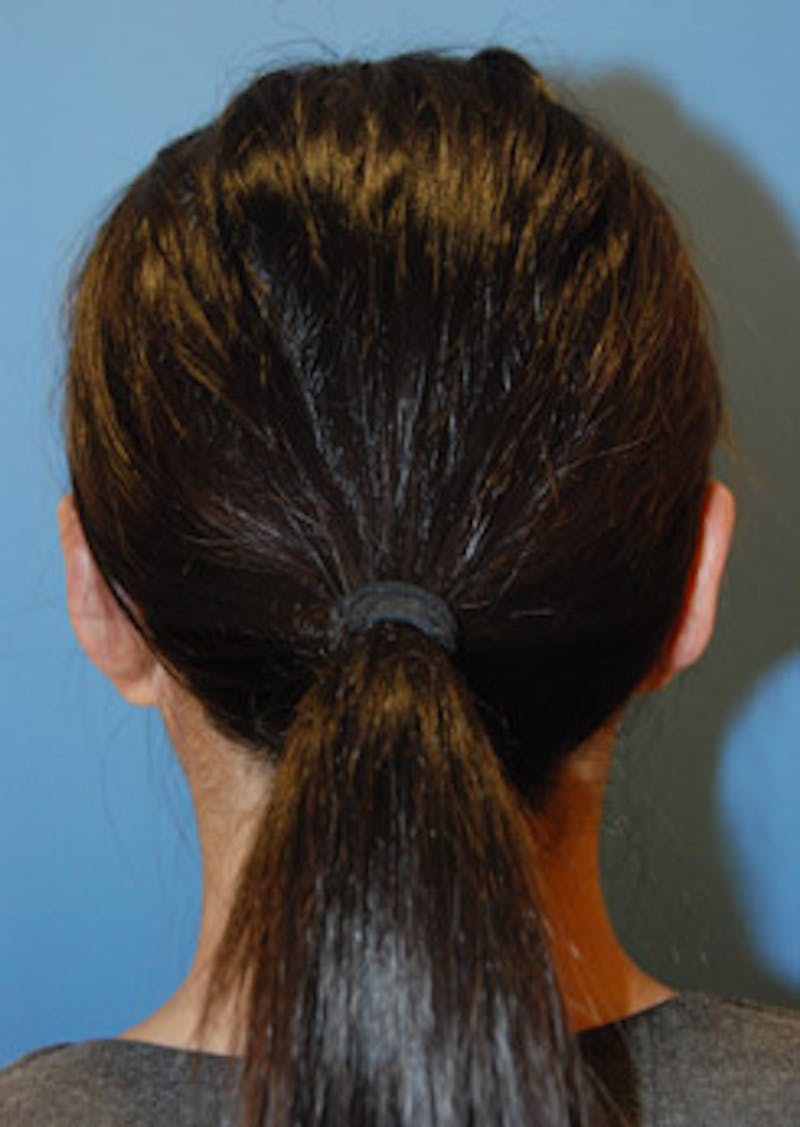 Ear Otoplasty Before & After Gallery - Patient 721663 - Image 4