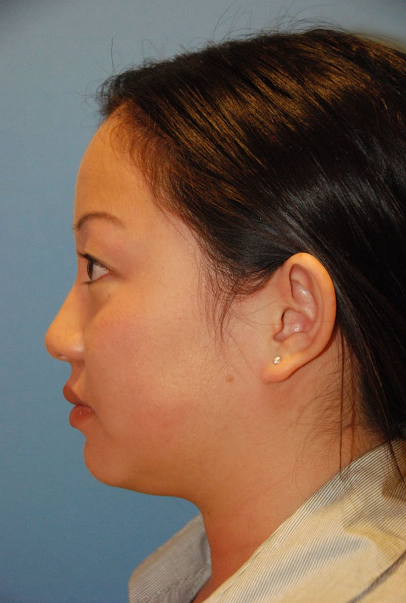 Ear Otoplasty Before & After Gallery - Patient 721663 - Image 5
