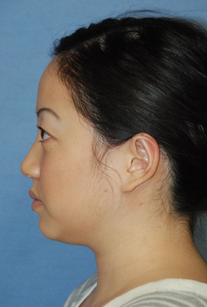 Ear Otoplasty Before & After Gallery - Patient 721663 - Image 6