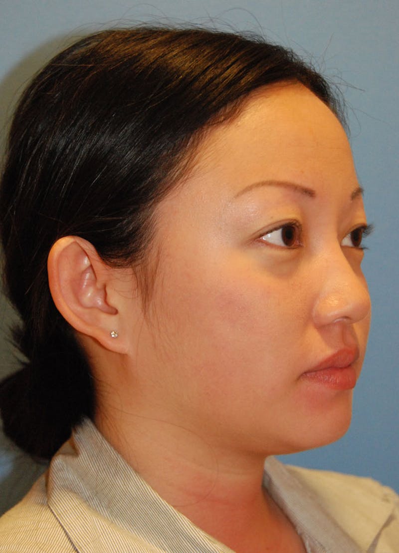 Ear Otoplasty Before & After Gallery - Patient 721663 - Image 7