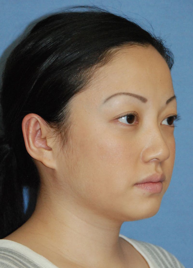 Ear Otoplasty Before & After Gallery - Patient 721663 - Image 8