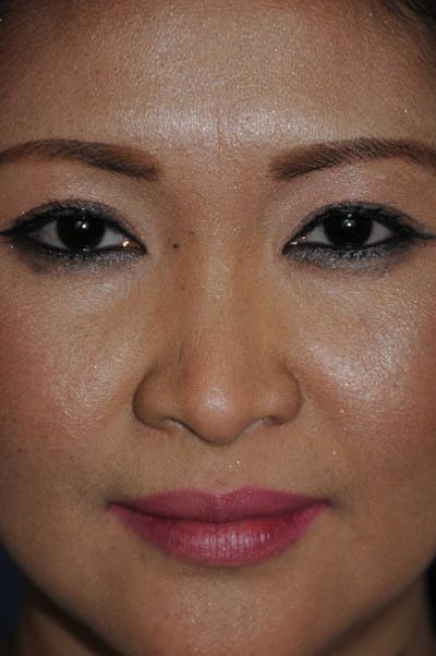 Rhinoplasty Before & After Gallery - Patient 466446 - Image 1