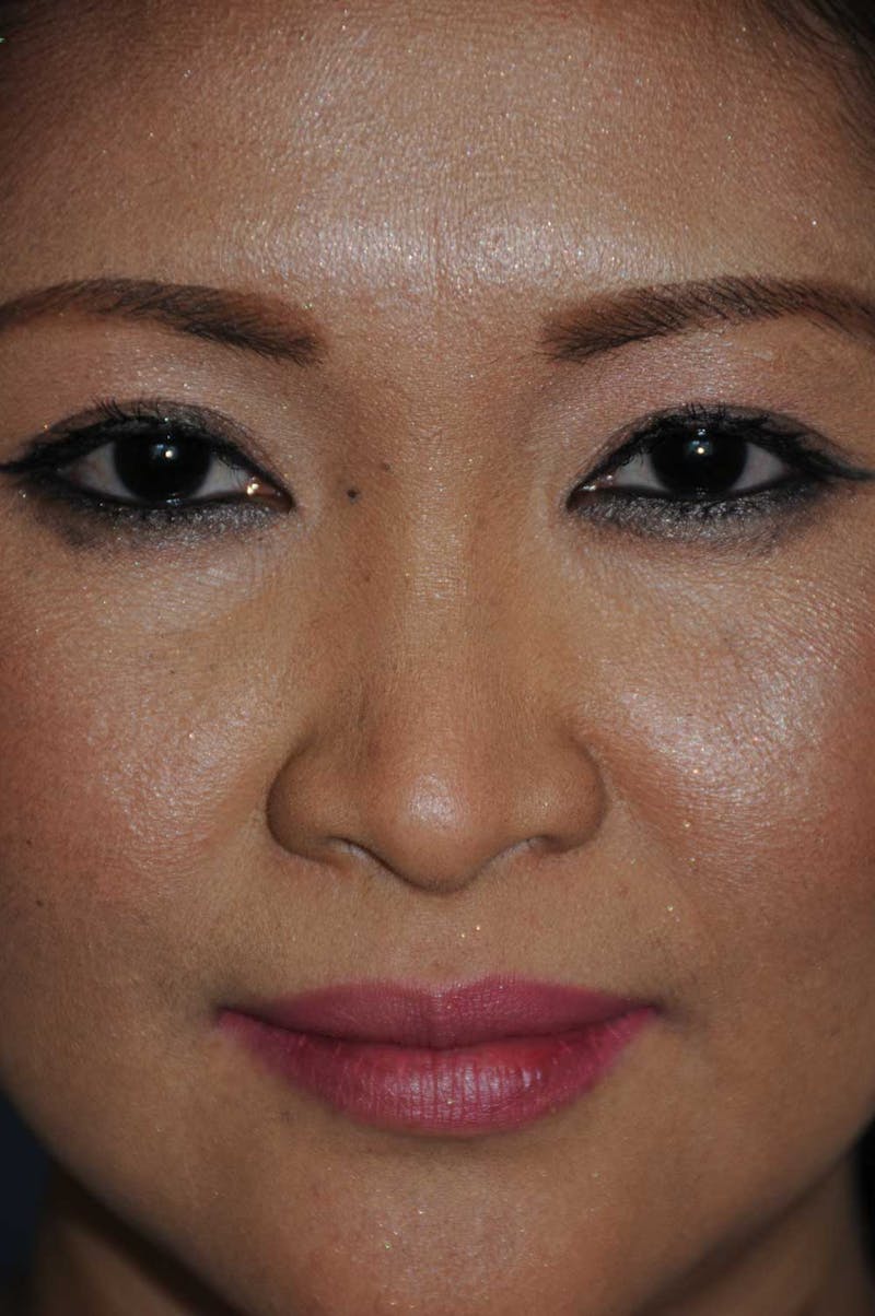 Rhinoplasty Before & After Gallery - Patient 466446 - Image 1