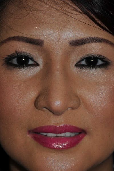Rhinoplasty Before & After Gallery - Patient 466446 - Image 2