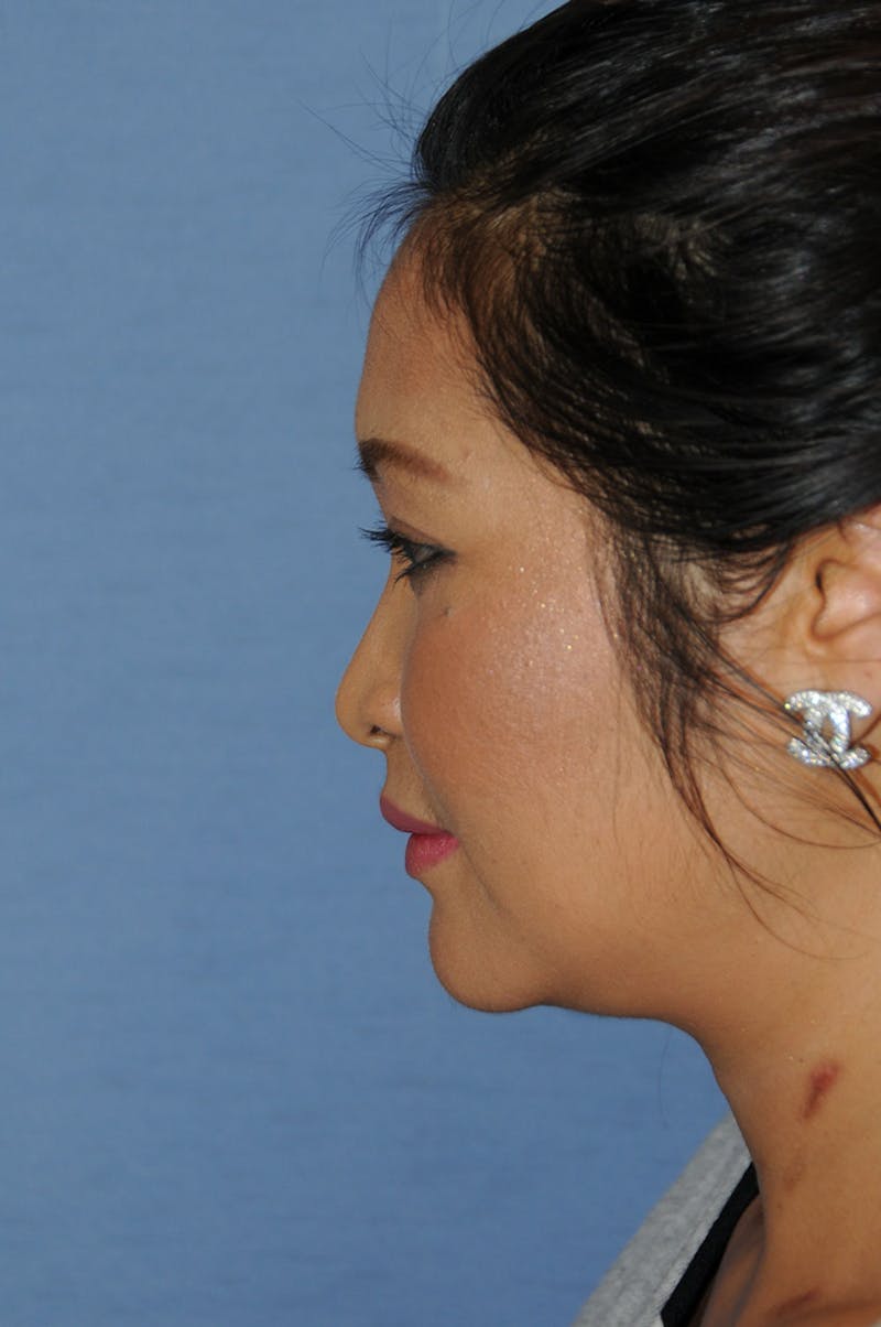 Rhinoplasty Before & After Gallery - Patient 466446 - Image 3