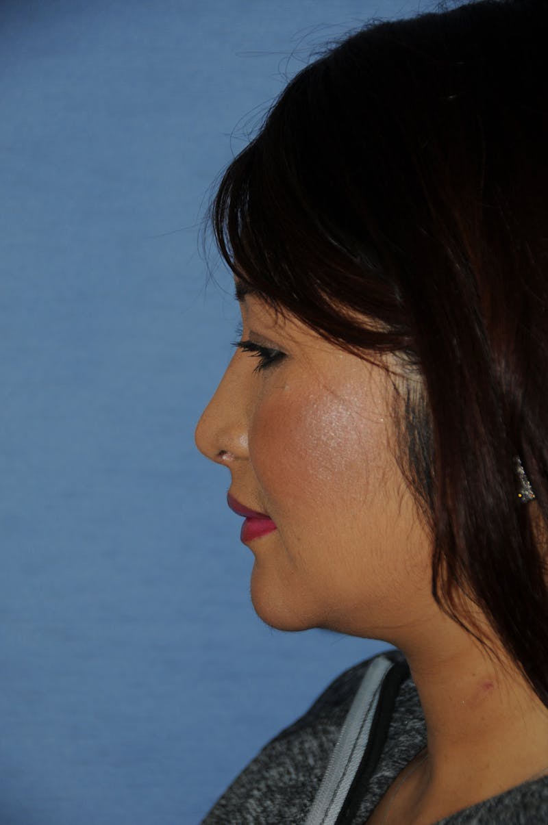 Rhinoplasty Before & After Gallery - Patient 466446 - Image 4