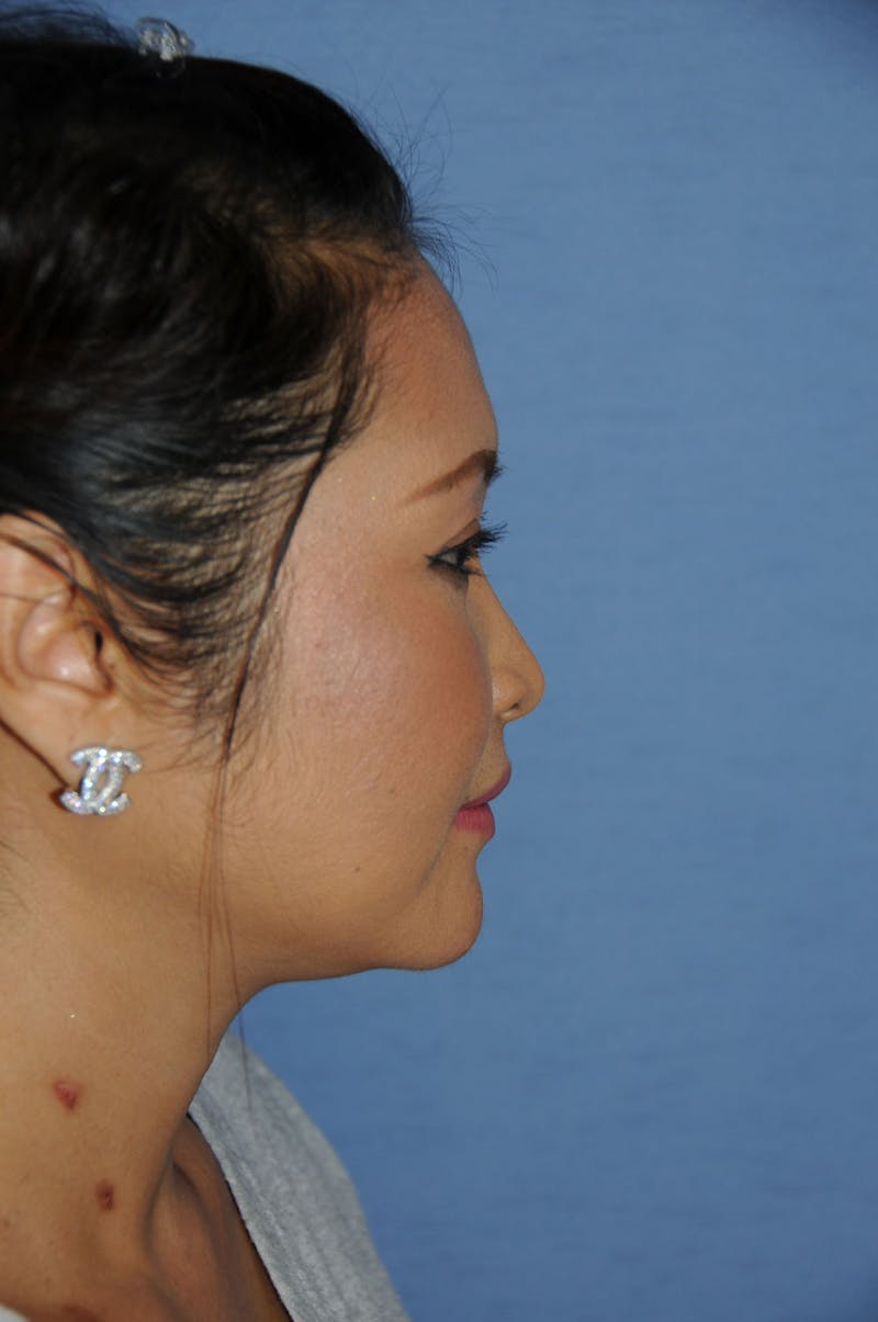 Rhinoplasty Before & After Gallery - Patient 466446 - Image 7