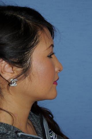 Rhinoplasty Before & After Gallery - Patient 466446 - Image 8