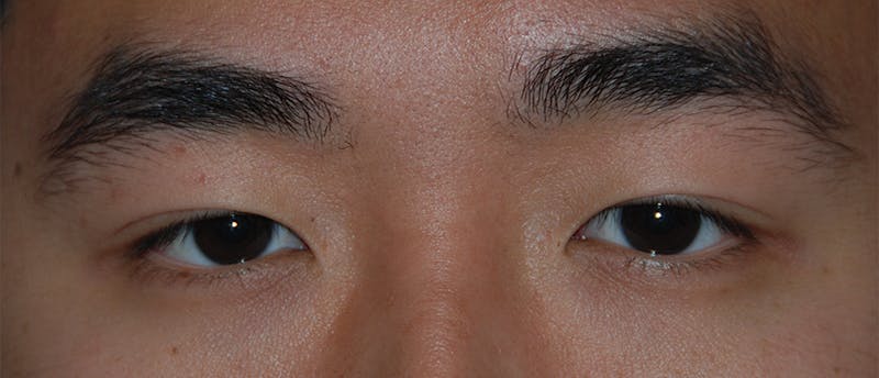 Eye Lift Before & After Gallery - Patient 239316 - Image 1